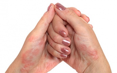 Mắc vảy nến 10 năm rồi có nên dùng Kim Miễn Khang và Explaq?