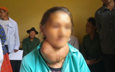 Người phụ nữ 70 tuổi phải sống chung với khối u khổng lồ suốt 30 năm