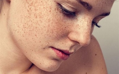 Tàn nhang là gì? Nguyên nhân gây tàn nhang