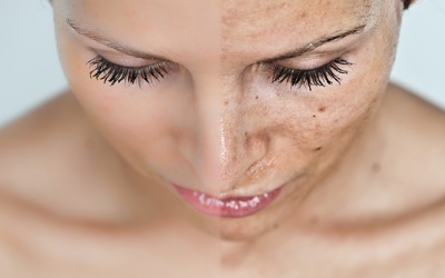 Cách trị nám hiệu quả không tốn kém