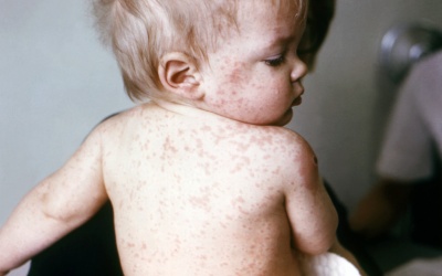 Trẻ bị sốt và nổi mẩn đỏ có phải bị bệnh sởi? 