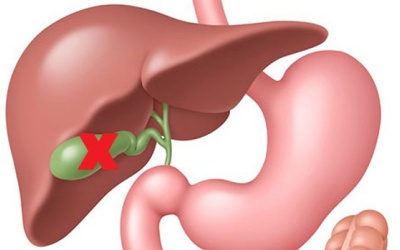 Phẫu thuật cắt túi mật: Đa số trường hợp là do sỏi mật
