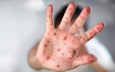 Cách điều trị bệnh tay chân miệng và phòng ngừa bệnh cho trẻ