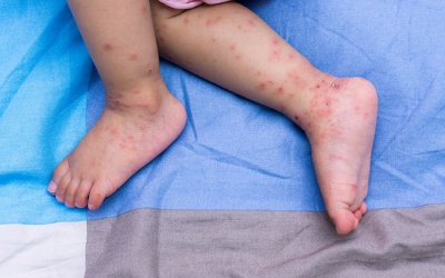 Những biến chứng nguy hiểm của bệnh tay chân miệng ở trẻ