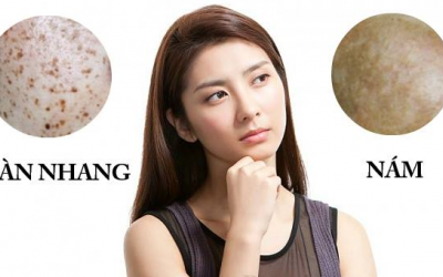 Nám và tàn nhang khác nhau thế nào?