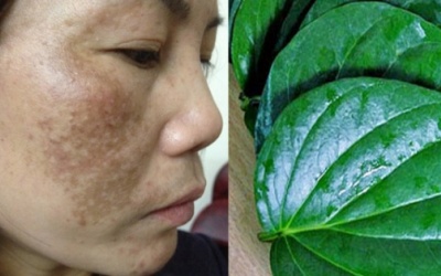 Trị nám bằng lá trầu không có hiệu quả?
