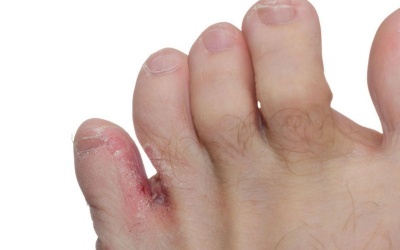 Gia đình có người bị nấm chân, làm sao để tránh bị lây bệnh?