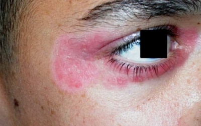 Biến chứng bệnh vẩy nến ảnh hưởng đến mắt như thế nào?