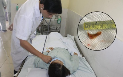Giải cứu cho cô gái hóc xương vịt trong 3 tháng