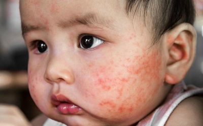 Trẻ 5 tháng tuổi bị eczema phải làm sao? 