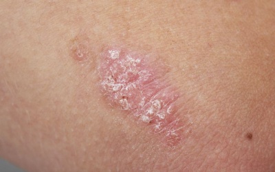 Những biện pháp giúp kiểm soát triệu chứng bệnh vẩy nến