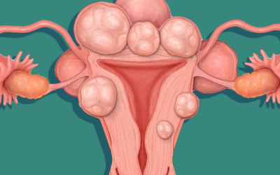 Cách tự nhiên giúp điều trị u xơ tử cung 