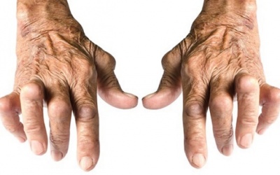 5 sự thật cần biết về viêm khớp dạng thấp