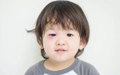 Đau mắt ở trẻ sơ sinh và trẻ nhỏ: Do đâu và điều trị thế nào?