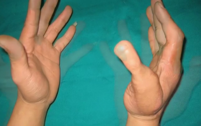 Phẫu thuật chuyển ngón chân thành ngón tay cái