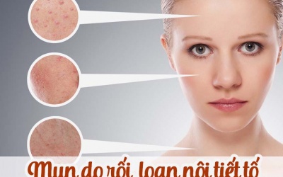 Vì sao rối loạn nội tiết tố lại gây mụn trứng cá?