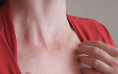 Ăn uống, vệ sinh thế nào để vẩy nến không nặng thêm?