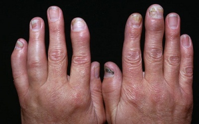 Giảm viêm khớp vẩy nến hiệu quả nhờ 7 biện pháp đơn giản 