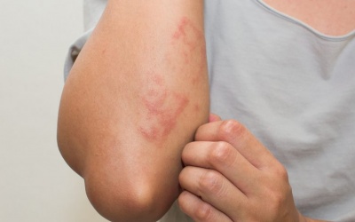 Hồng ban nút hay tái phát cải thiện bằng cách nào?