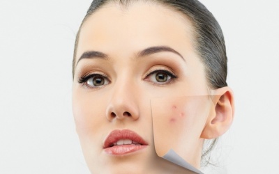 Những nguyên nhân khiến người trưởng thành bị mụn