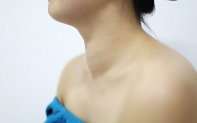 Bướu giáp 15 năm không điều trị, bệnh nhân gặp nguy do khối u chèn ép khí quản