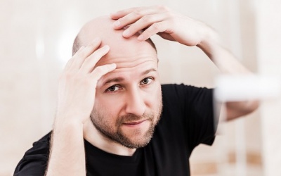 Rụng tóc từng mảng phải làm sao?