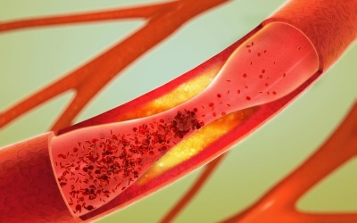 5 cách giúp động mạch luôn khỏe, phòng ngừa đau tim