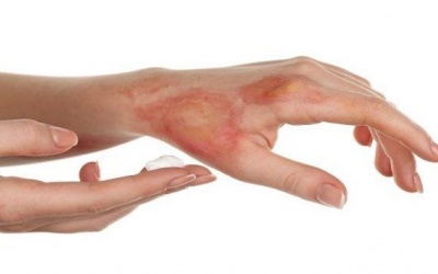 5 cách giúp chữa bỏng và ngăn ngừa hình thành sẹo bỏng hiệu quả