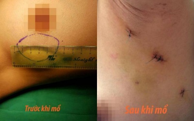 Không lo bị sẹo khi mổ u xơ tuyến vú qua đường nách