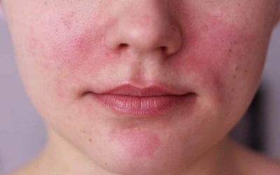 7 thực phẩm có thể kích hoạt bệnh đỏ mặt rosacea