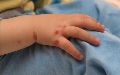 20 cách điều trị bệnh tay chân miệng ngay tại nhà