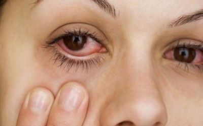 5 nguyên nhân khiến mắt bạn bị đỏ