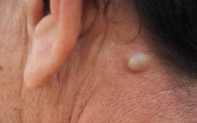 Nổi u ở cổ và tai do đâu?
