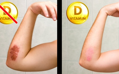 8 dấu hiệu cho thấy cơ thể bạn đang cần bổ sung vitamin D