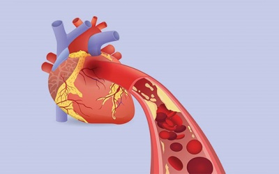 Làm sao để nhận biết thiếu máu cơ tim thầm lặng?