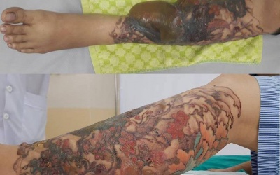Xóa xăm bằng laser, cô gái suýt bị hoại tử chân vì bỏng độ 3