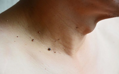 Những quan niệm sai lầm về mụn thịt dư