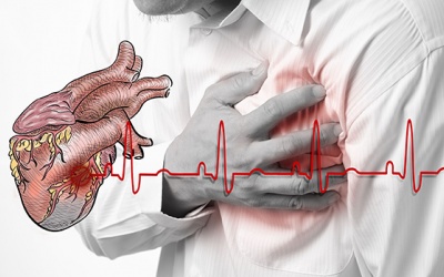 Nên dùng phương pháp chụp mạch vành nào để chẩn đoán thiếu máu cơ tim?