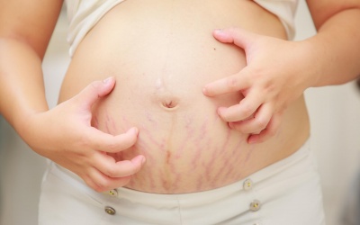 6 cách giúp mẹ bầu giảm ngứa khi mang thai