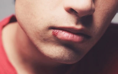 Video: Nên làm gì để đối phó với rộp môi?