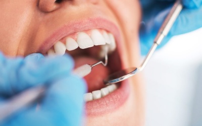 5 lời khuyên giúp ngăn ngừa sâu răng tối ưu