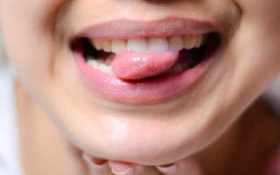 Thường xuyên nhiệt miệng, loét miệng có nguy hiểm không?