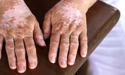 3 cách tự nhiên chữa lang ben ngay tại nhà