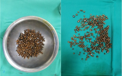 Kinh hoàng: Gần 400 viên sỏi nằm trong túi mật bệnh nhân 60 tuổi!