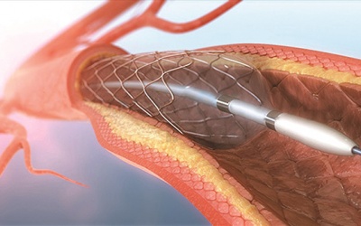 Stent là gì, khi nào người bệnh thiếu máu cơ tim nên đặt stent mạch vành?
