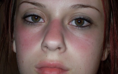 15 triệu chứng của lupus ban đỏ ít người để ý