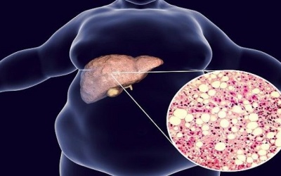 Nói 'không' với những thực phẩm này nếu đang bị gan nhiễm mỡ không cồn