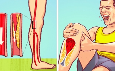7 dấu hiệu tắc động mạch nguy hiểm thường bị bỏ qua