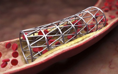 Đặt nhiều stent có ảnh hưởng gì tới người bị thiếu máu cơ tim?