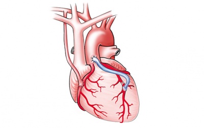Phương pháp bắc cầu động mạch vành là gì, thực hiện thế nào?